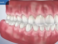 Cracked Tooth