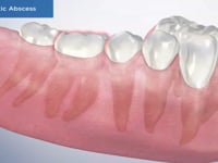 Endodontic Abscess