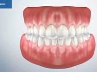 Root Canal