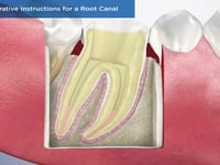 Post-Operative Instructions for a Root Canal