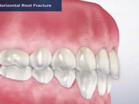 Trauma- Horizontal Root Fracture
