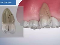 Vertical Root Fracture