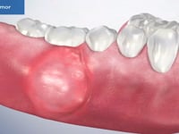 Dental Tumor