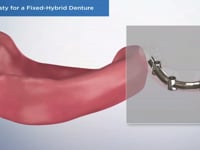 Alveoplasty for a Fixed-Hybrid Denture