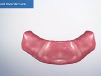 Bar Retained Overdenture