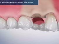 Bone Graft with Immediate Implant Placement
