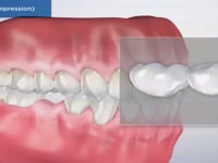 Bridge Versus an Implant
