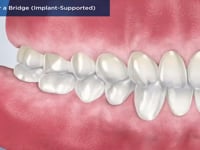 Caring for a Bridge (Implant-Supported)