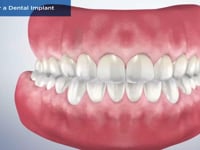Caring for a Dental Implant
