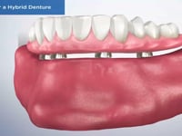 Caring for a Hybrid Denture