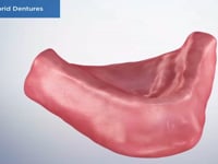 Fixed Hybrid Dentures