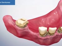 Immediate Denture