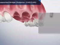 Implant-Supported Bridge (Anterior- CADCAM)