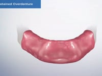 Locator Retained Overdenture