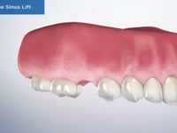 Osteotome Sinus Lift