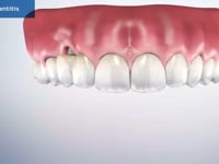 Peri-Implantitis