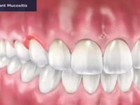 Peri-Implant Mucositis