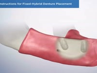 Post-Op Instructions for Fixed-Hybrid Denture Plac