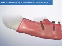 Post-Operative Instructions for a Bar-Retained Ove