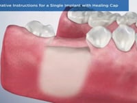 Post-Operative Instructions for a Single Implant with Healing Cap