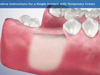Post-Operative Instructions for a Single Implant with Temporary Crown