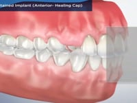 Screw-Retained Implant (Anterior- Healing Cap)