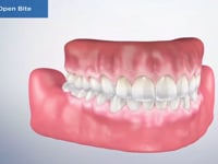 Anterior Open Bite