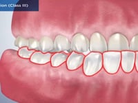 Malocclusion (Class III)