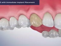 Bone Graft with Immediate Implant Placement