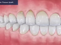 Connective Tissue Graft