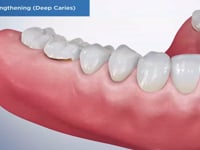 Crown Lengthening (Deep Caries)