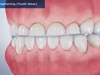 Crown Lengthening (Tooth Wear)