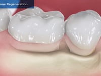 Guided-Bone Regeneration