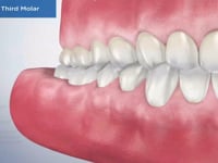 Impacted Third Molar