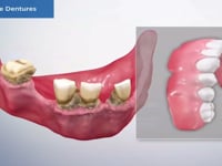 Immediate Denture