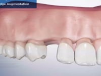 Lateral Ridge Augmentation