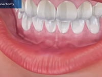 Labial Frenectomy