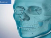 Maxillary Expansion
