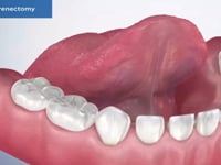 Lingual Frenectomy