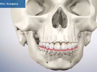 Orthognathic Surgery