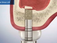 Osteotome Sinus Lift