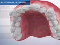 Post-Op Care for Maxillary Expansion