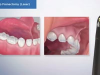 Post-Op Frenectomy (Laser)