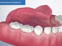 Post-Op Frenectomy (Surgical)