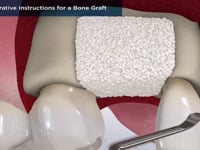 Post-Operative Instructions for a Bone Graft