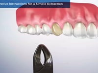 Post-Operative Instructions for a Simple Extractio