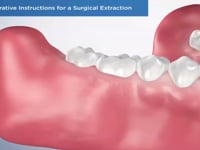 Post-Operative Instructions for a Surgical Extract