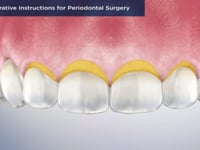 Post-Operative Instructions for Periodontal Surger