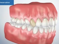 Socket Preservation