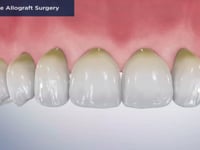Soft-Tissue Allograft Surgery